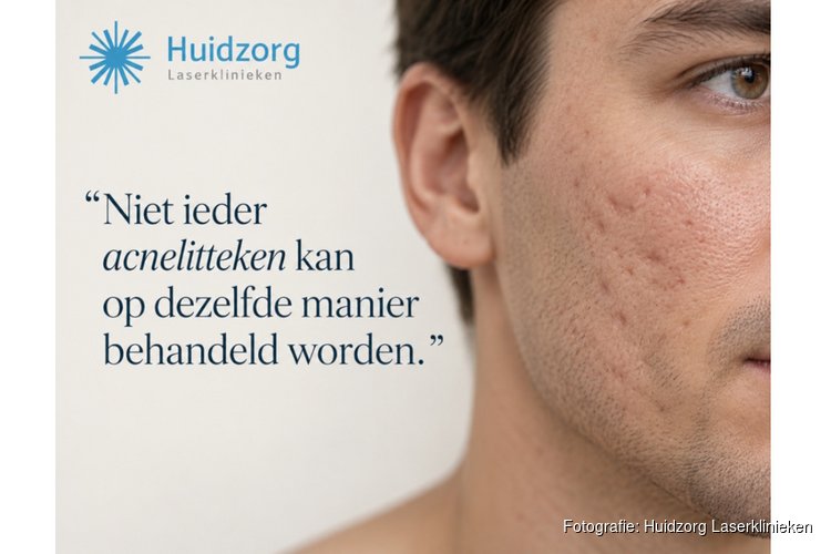 Acnelittekens behandelen: waarom het soort litteken bepaalt wat werkt?